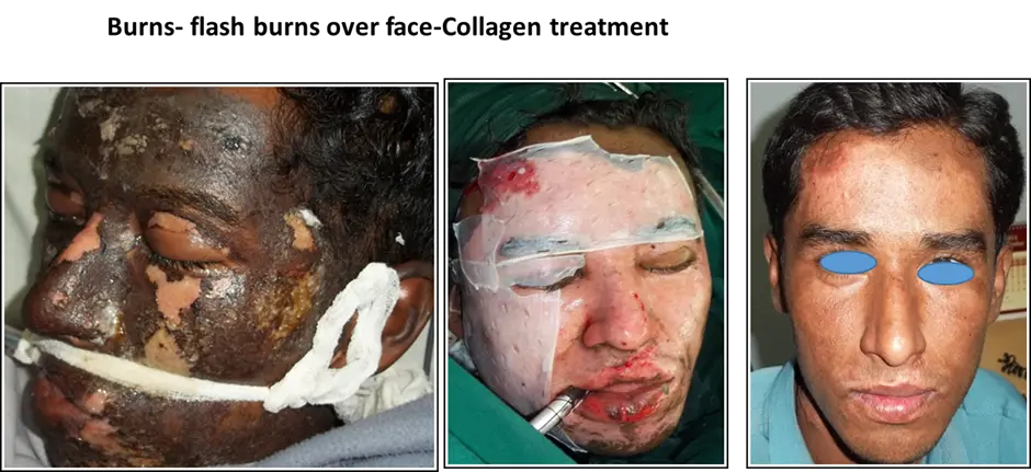 burn flash, burns over face - collagen treatment